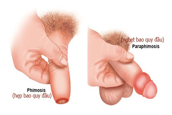 cách chữa hẹp bao quy đầu