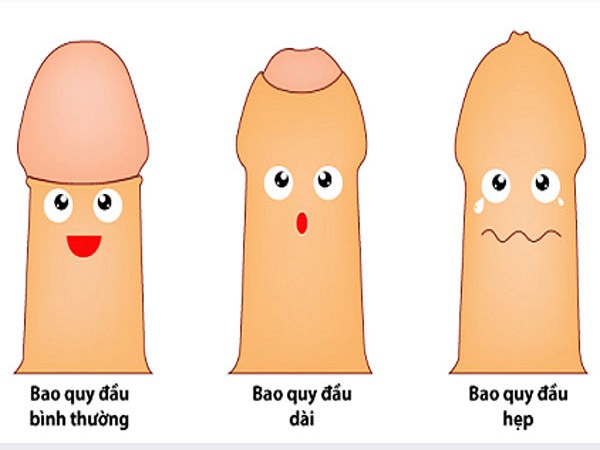 20 tuôi bị hẹp bao quy đầu