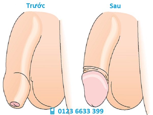 hình ảnh bao quy đầu trước và sau khi cắt