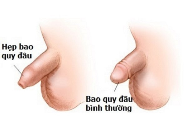 tre nhỏ hẹp bao quy đầu