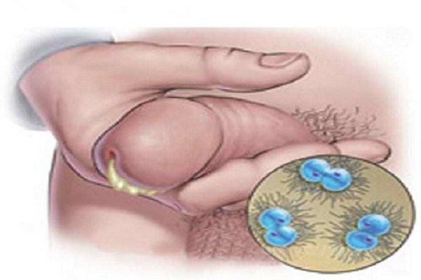 sau cắt bao quy đầu bị chảy mủ