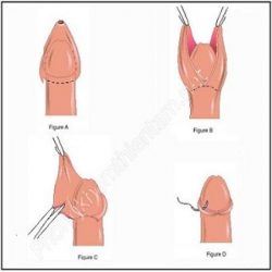 Lợi ích của cắt bao quy đầu là gì có ảnh hưởng gì không