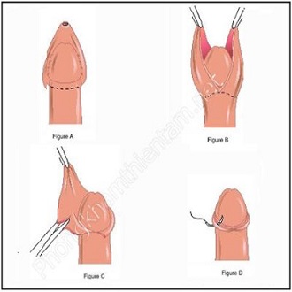 Lợi ích của cắt bao quy đầu là gì có ảnh hưởng gì không