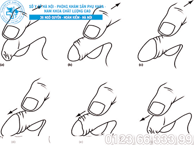 cách vệ sinh khi bị viêm bao quy đầu