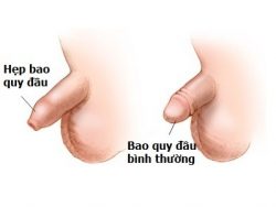 Có nên cắt bao quy đầu cho trẻ sơ sinh không 1