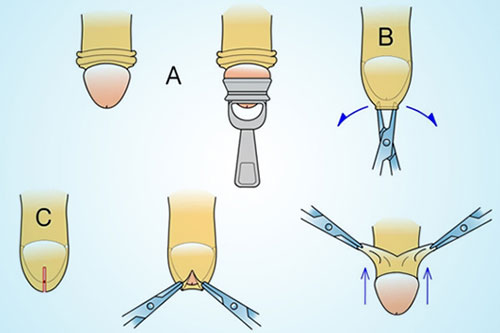 Tìm địa chỉ cắt bao quy đầu ở đâu Hà Nội