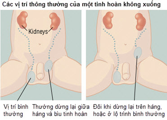 Hình ảnh ẩn tinh hoàn ở trẻ 1