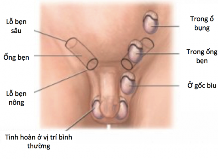 Hình ảnh ẩn tinh hoàn ở trẻ 2